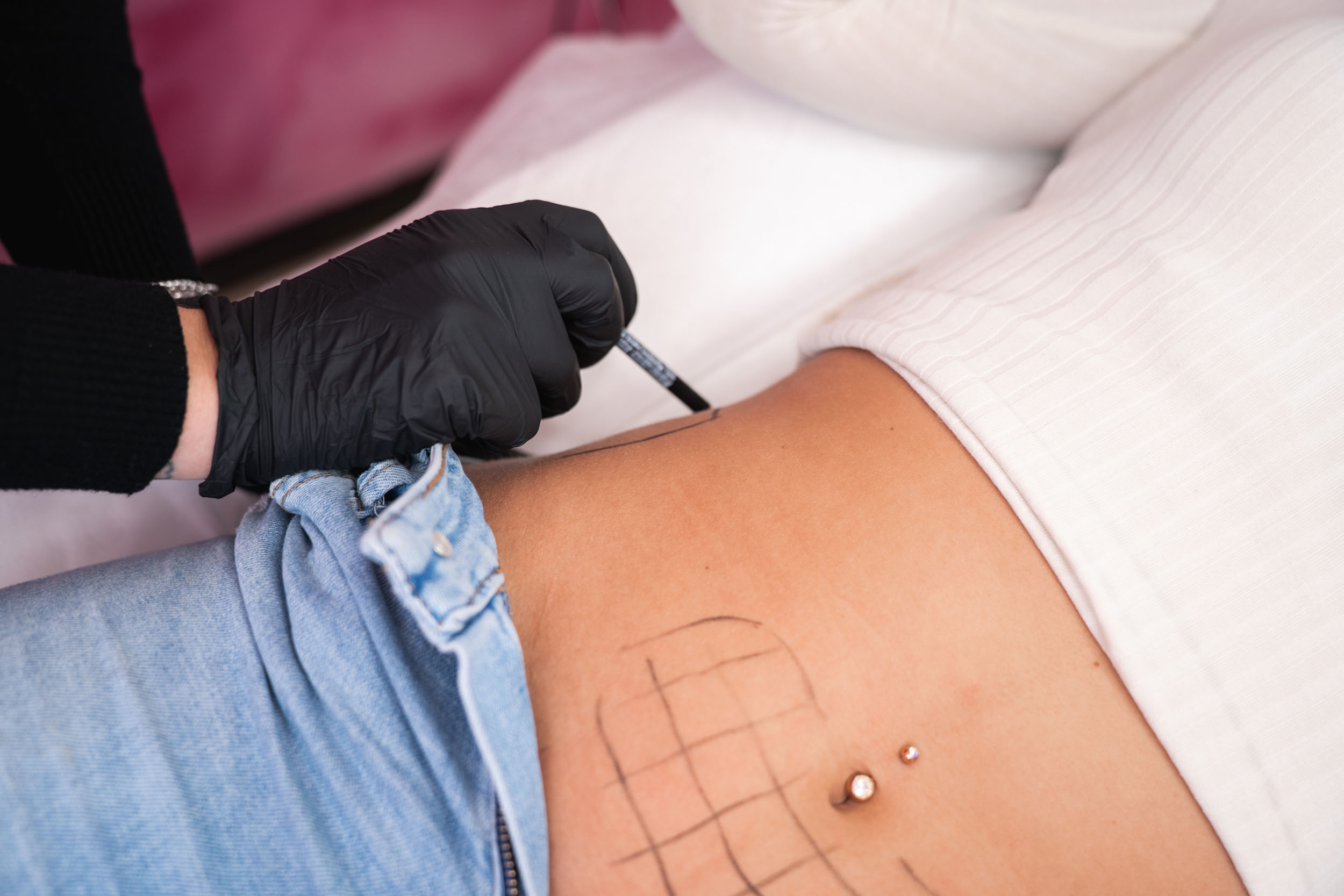 Lipo injections at FillerHouse