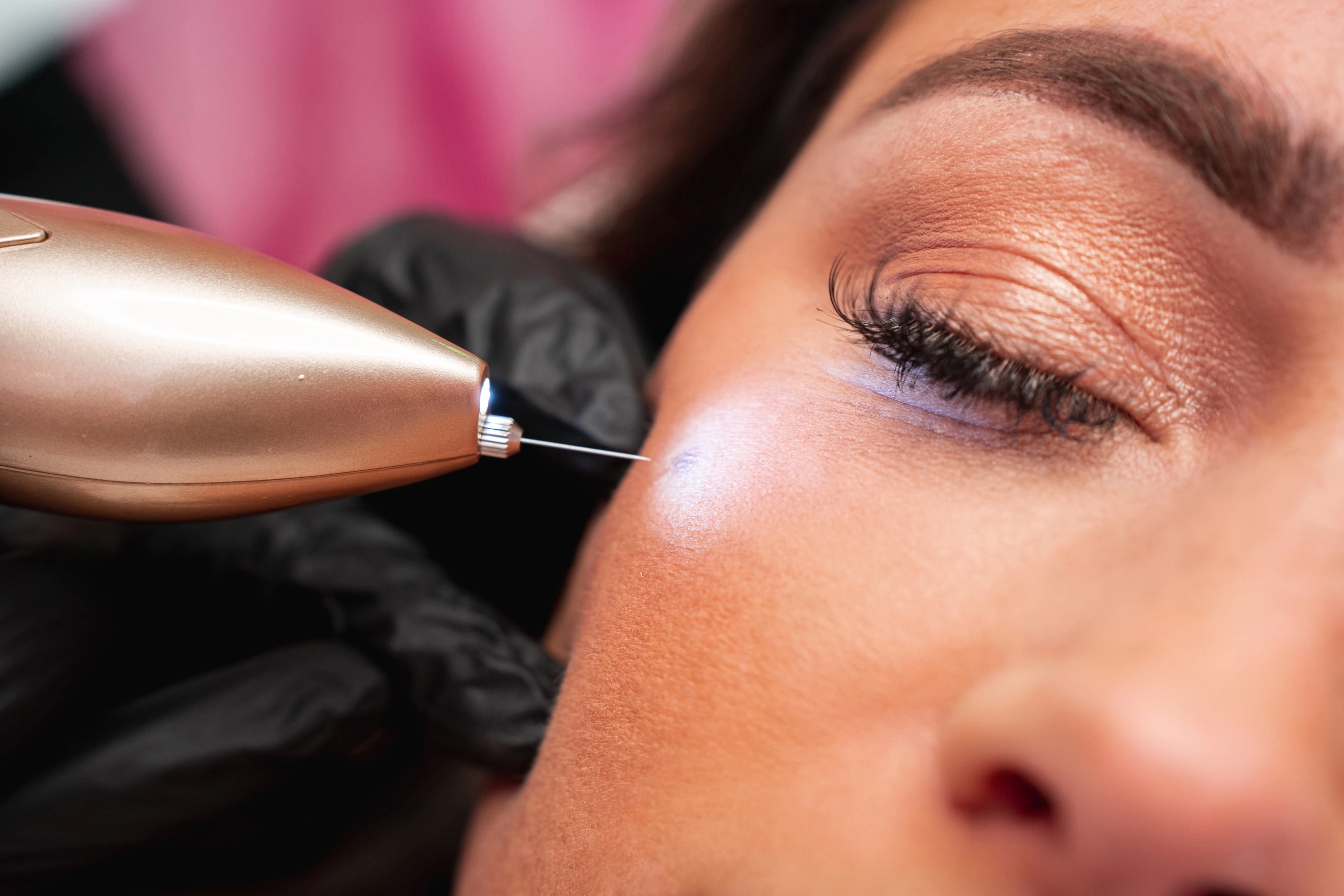 Remove skin tags