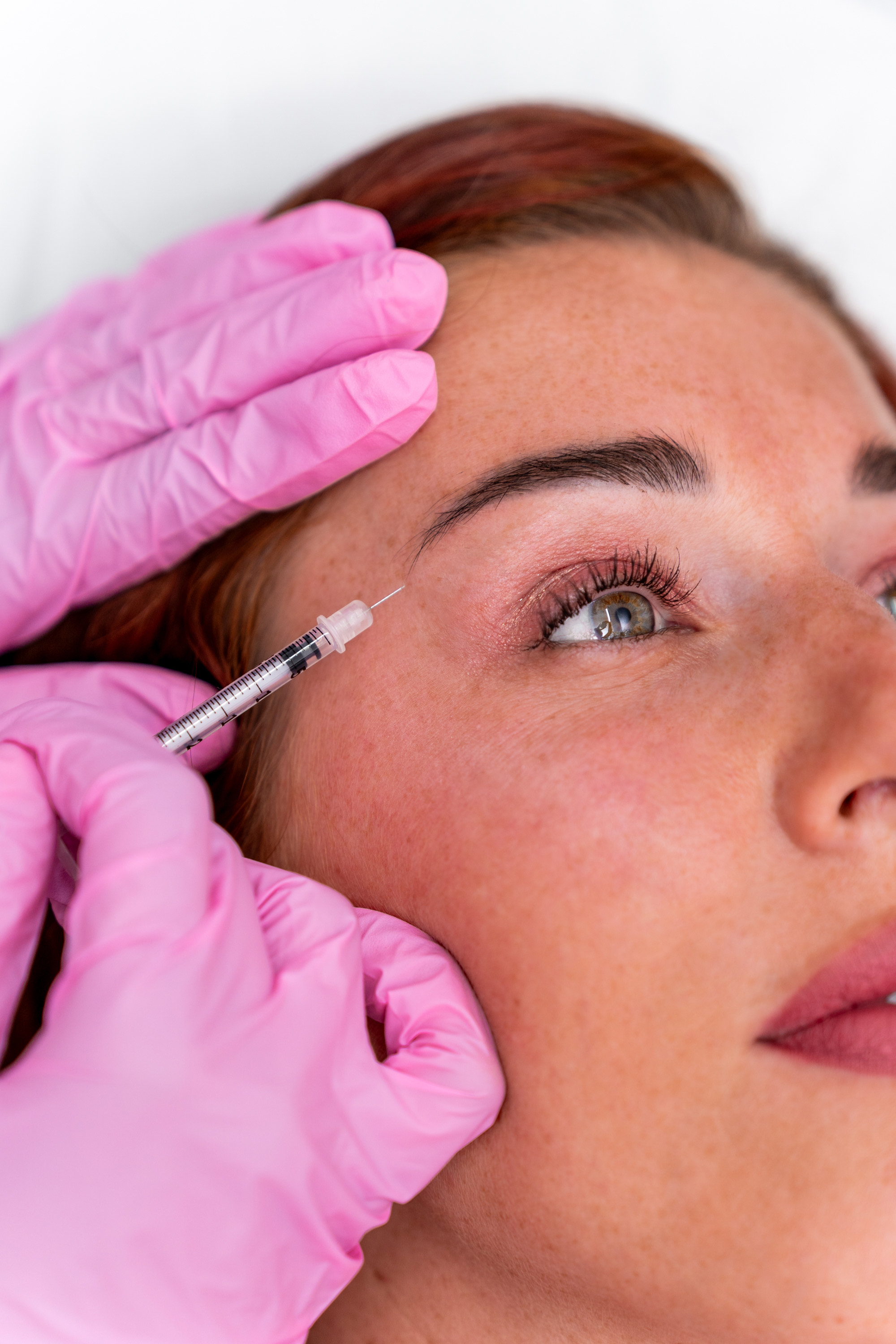 Botox voorhoofd behandeling