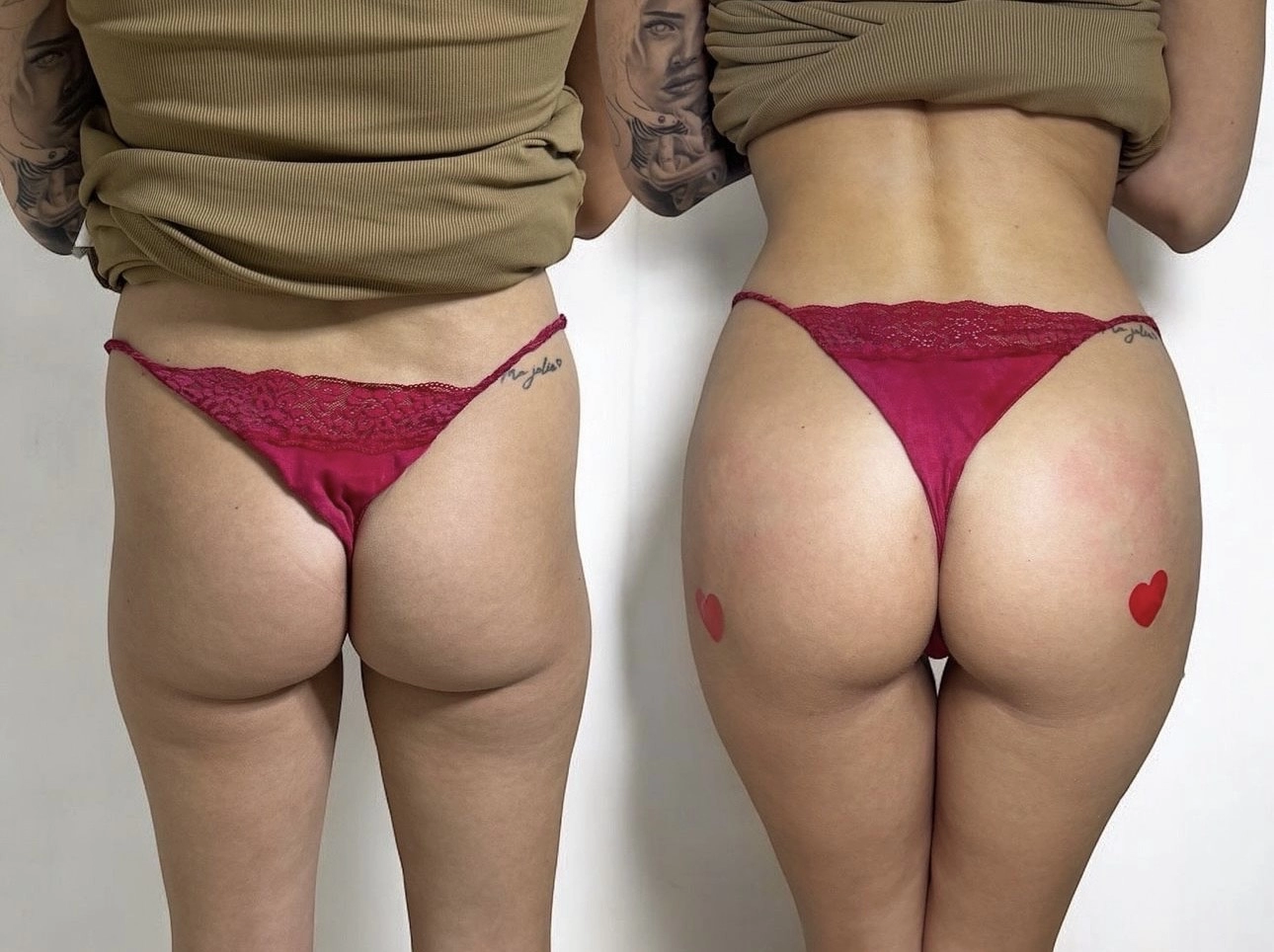 Buttock fillers before and after